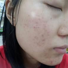 初中生青春痘到底用不用治疗吗